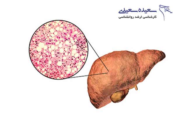 کبد گرید ۲